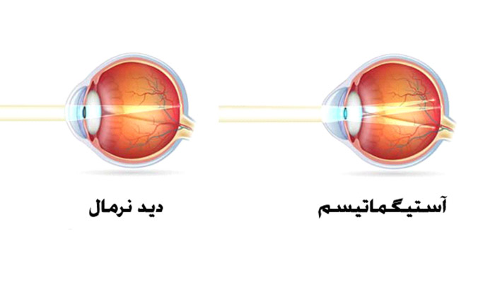 آستیگماتیسم چیست؟